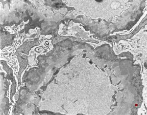  M,36y. | membranous glomerulopathy - late stage